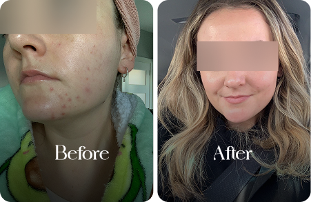 sn-before-after-img1