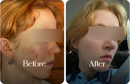 sn-before-after-img2