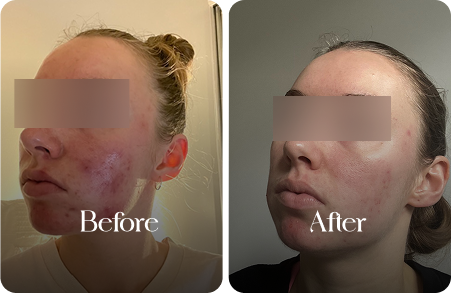 sn-before-after-img3